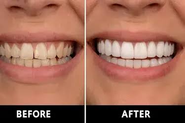 The Case That Already Has Veneers
